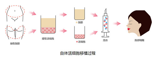 微整形培训之自体脂肪填充技术