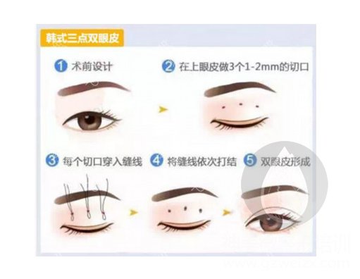 韩式三点双眼皮