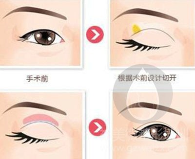 双眼皮切开法