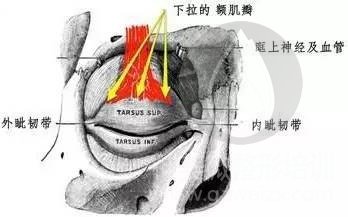 额肌提吊手术