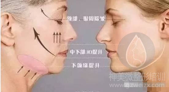4D埋线