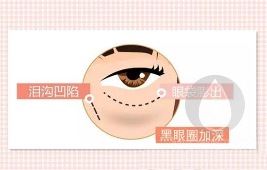 玻尿酸去黑眼圈