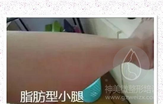 脂肪性小腿