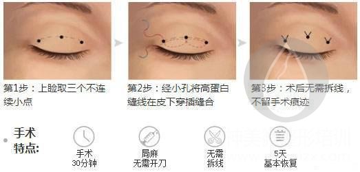 埋线双眼皮手术