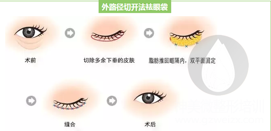 外路径切开法