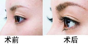 睫毛移植效果图
