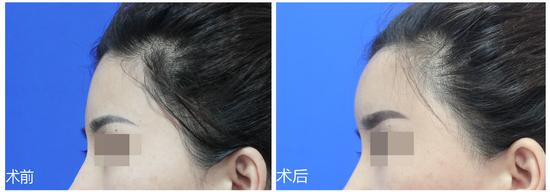 feng太阳穴