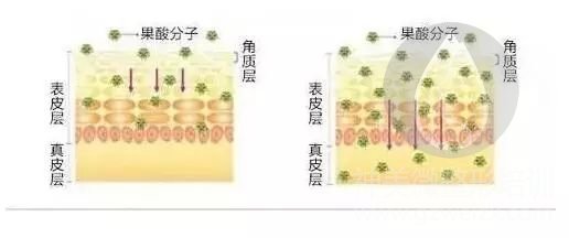 果酸换肤