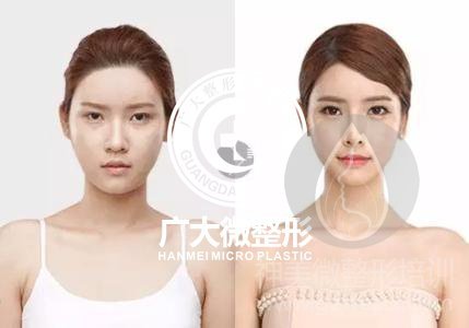 隆鼻手术之前你有必要知道的-微整形练习