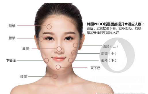 线雕